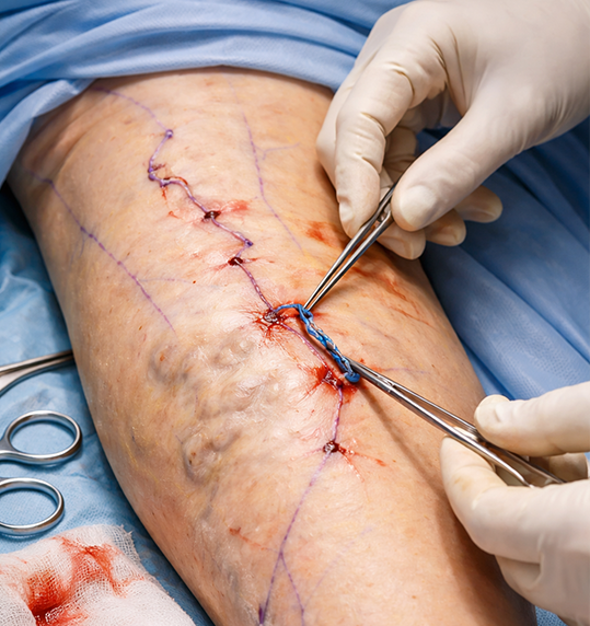 Varicose Veins
